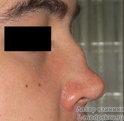 осложнения операции на носе